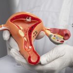 Mulheres com SOP apresentam quadruplicação do risco de doenças cardiovasculares