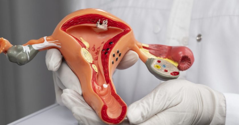 Mulheres com SOP apresentam quadruplicação do risco de doenças cardiovasculares